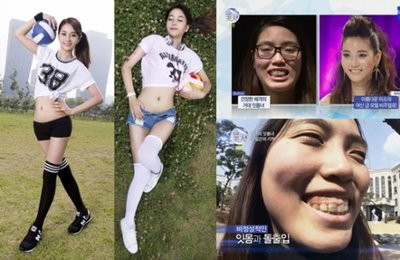 렛미인4 성형수술…치료를 위한 것인가, 미용을 위한 것인가