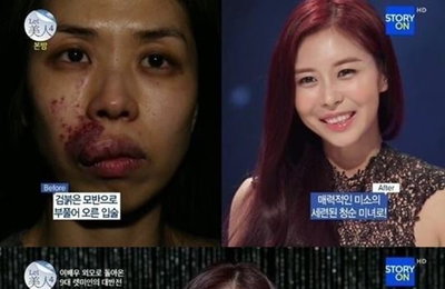 렛미인4 김희은, 모반 제거하고 나니 청순미녀 탄생